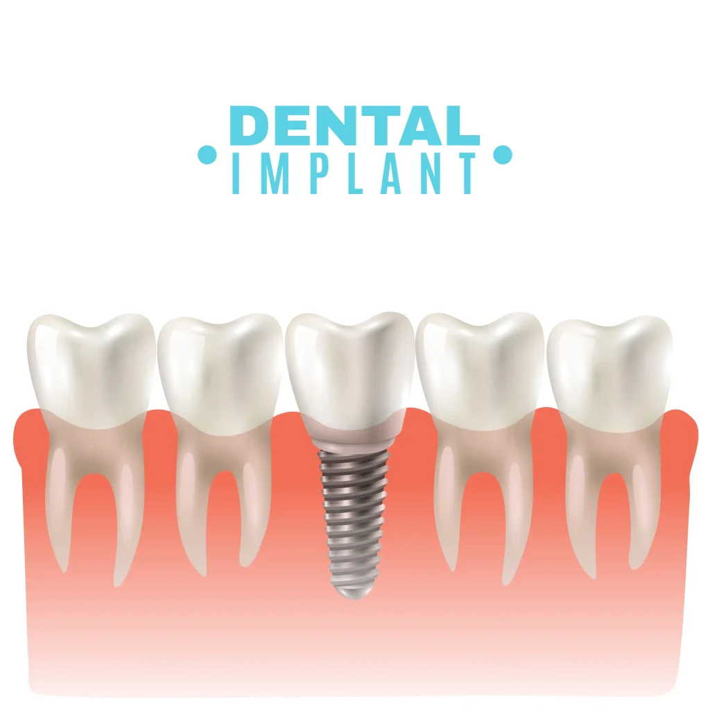 Dental Implant Guide