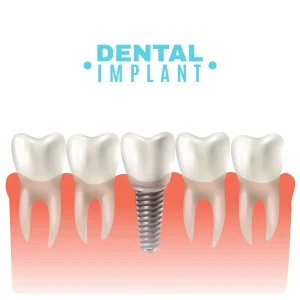 Dental Implant Guide