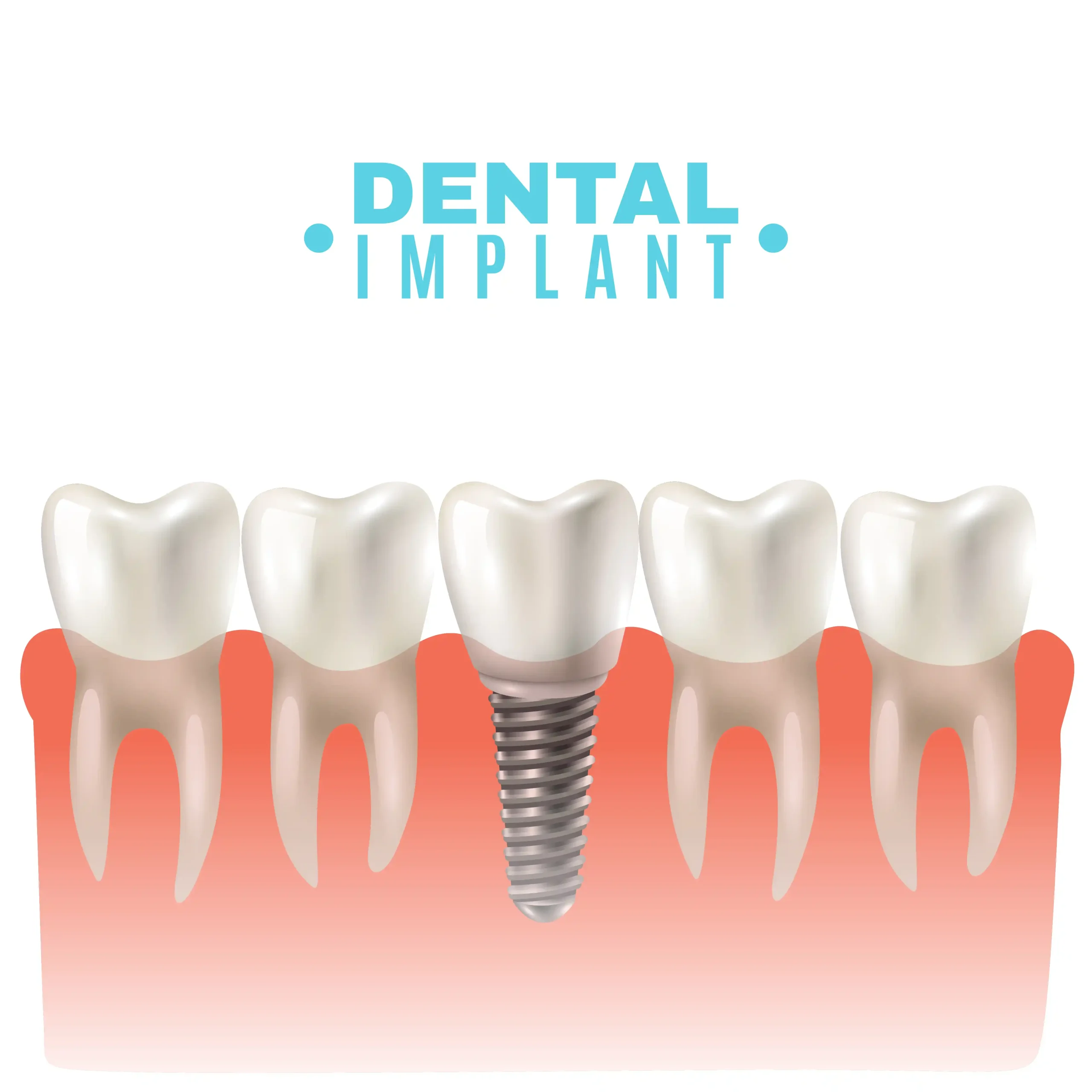 Dental Implant Guide