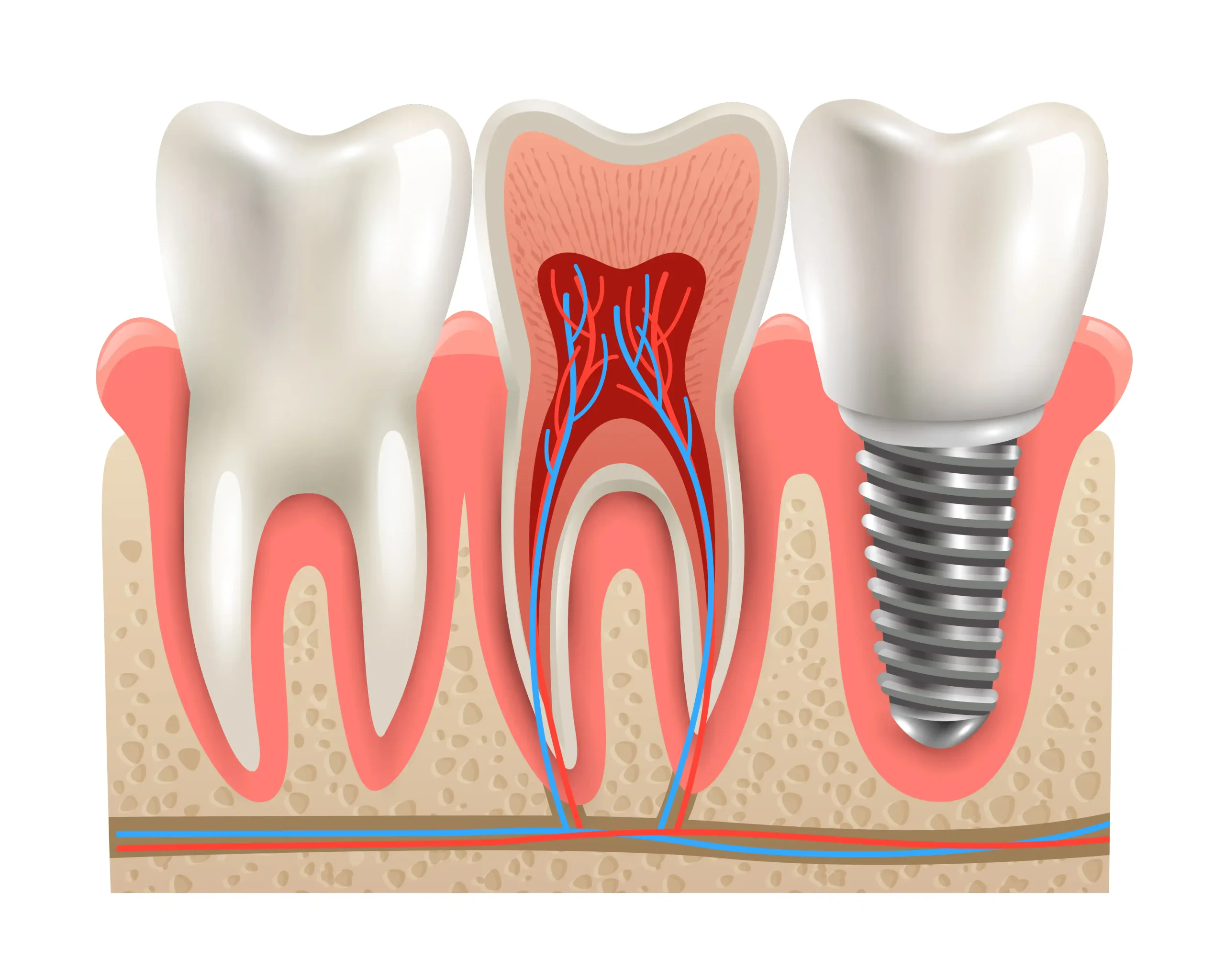 Dental Implants in Cudahy