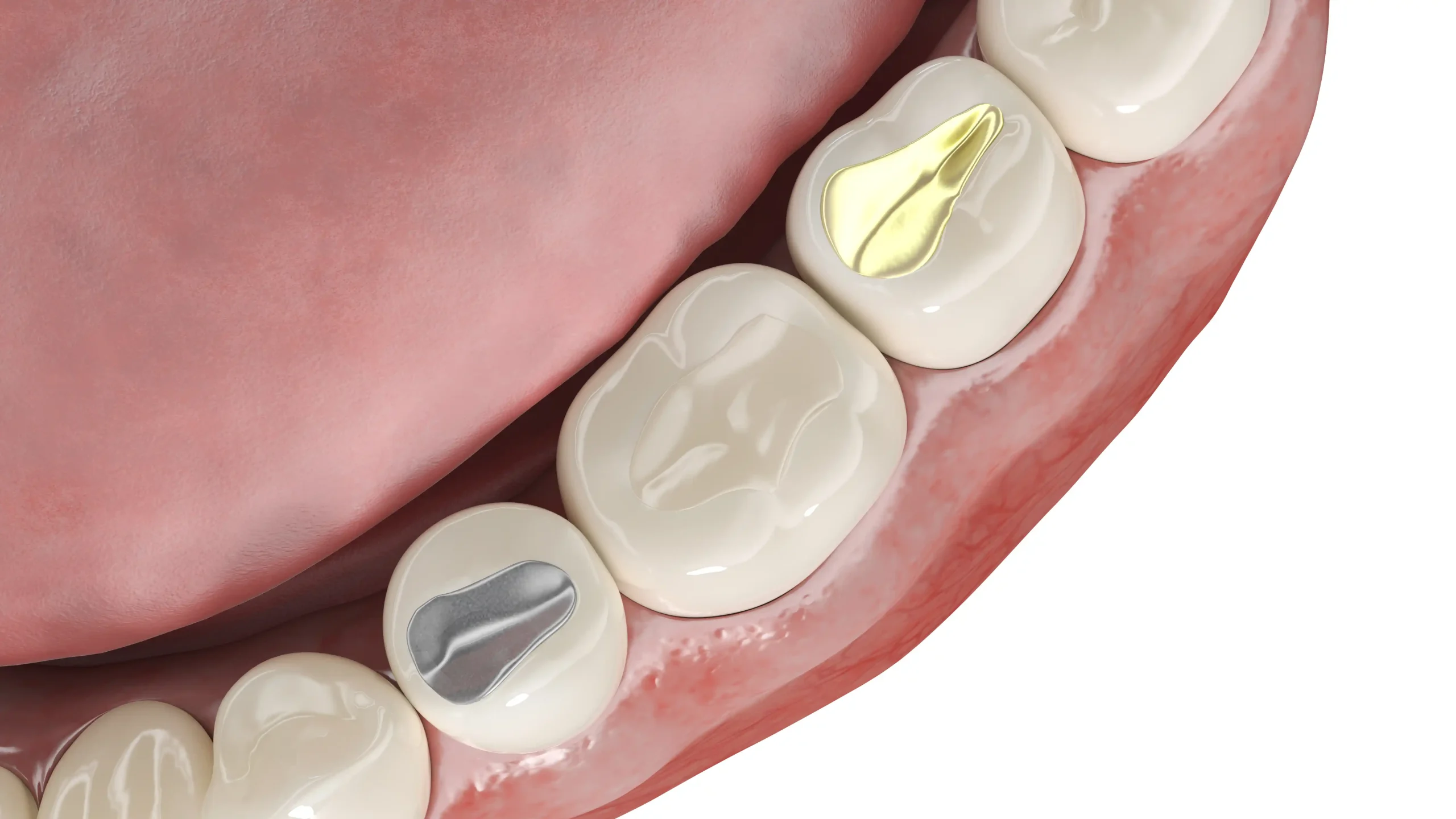 Dental Filling