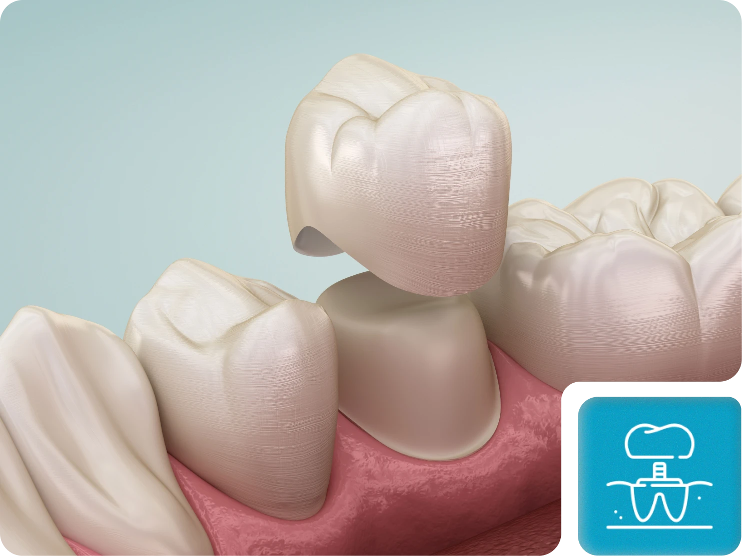 Dental Crowns By South Shore Dentistry & Implants