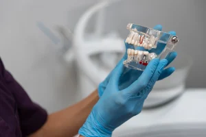 Dental Implants services