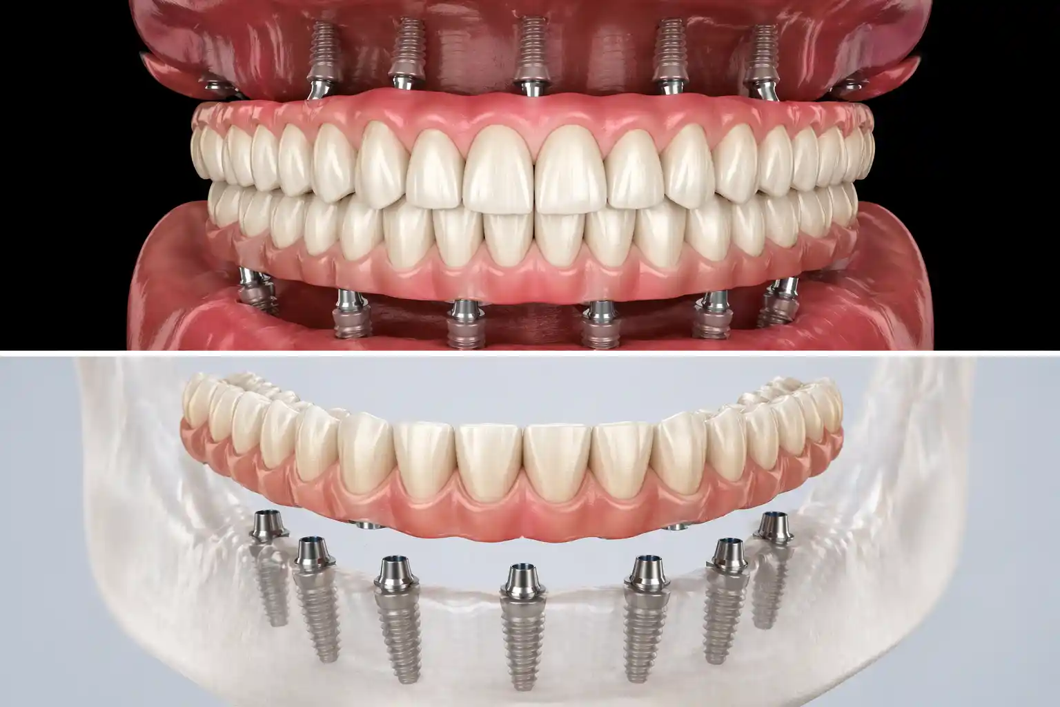 Full mouth dental implant in cudahy WI
