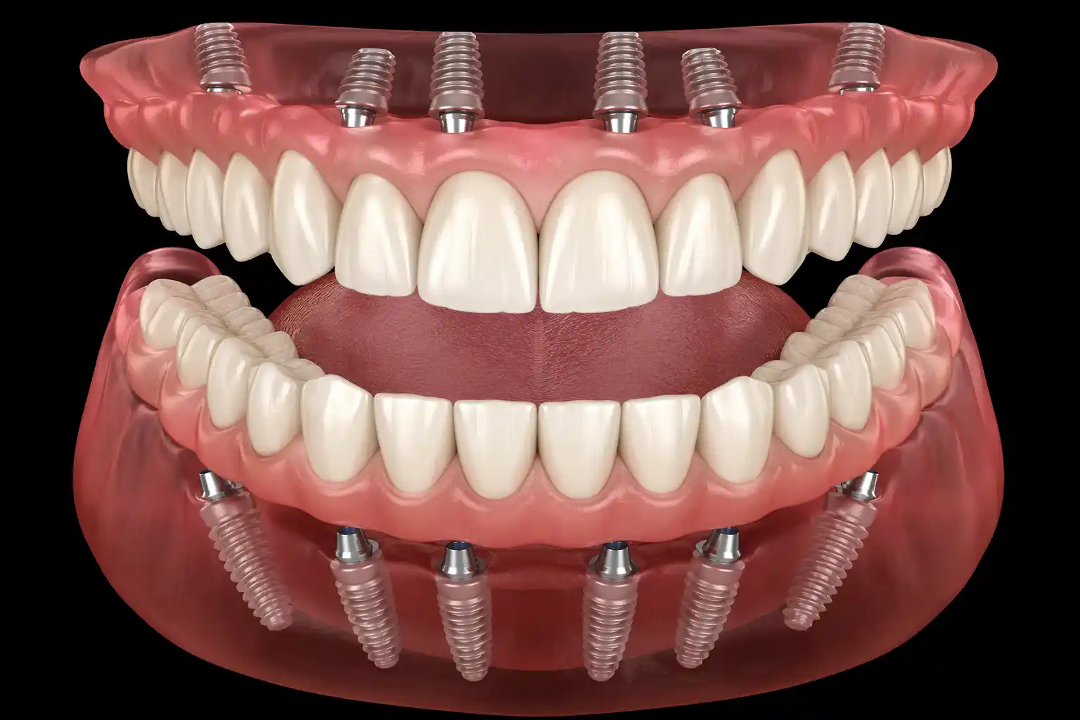 Full mouth dental implant in cudahy