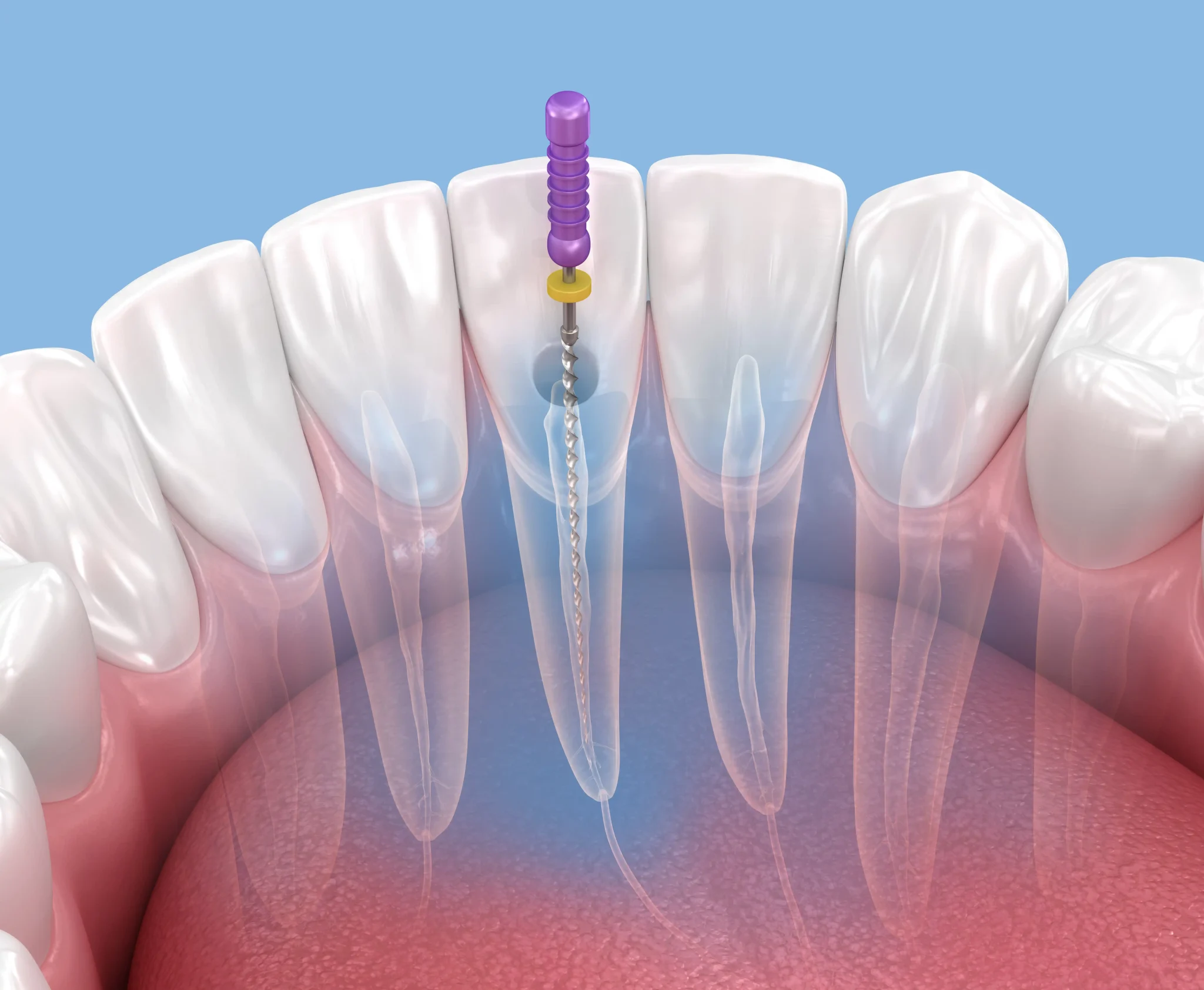 Root canal treatment