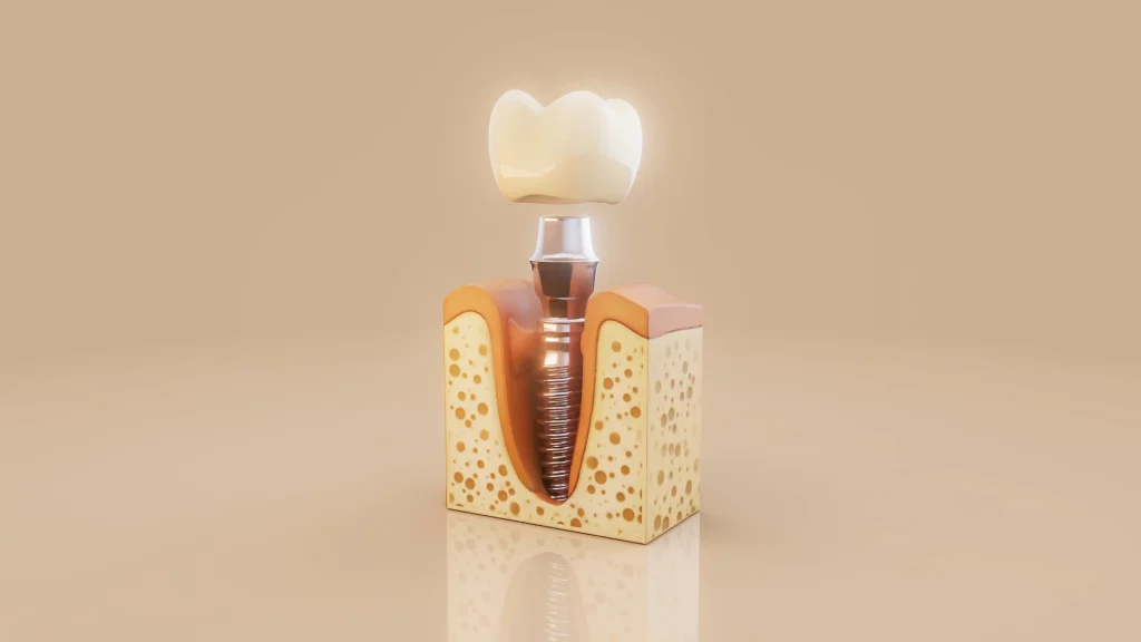 Dental Implant Guide