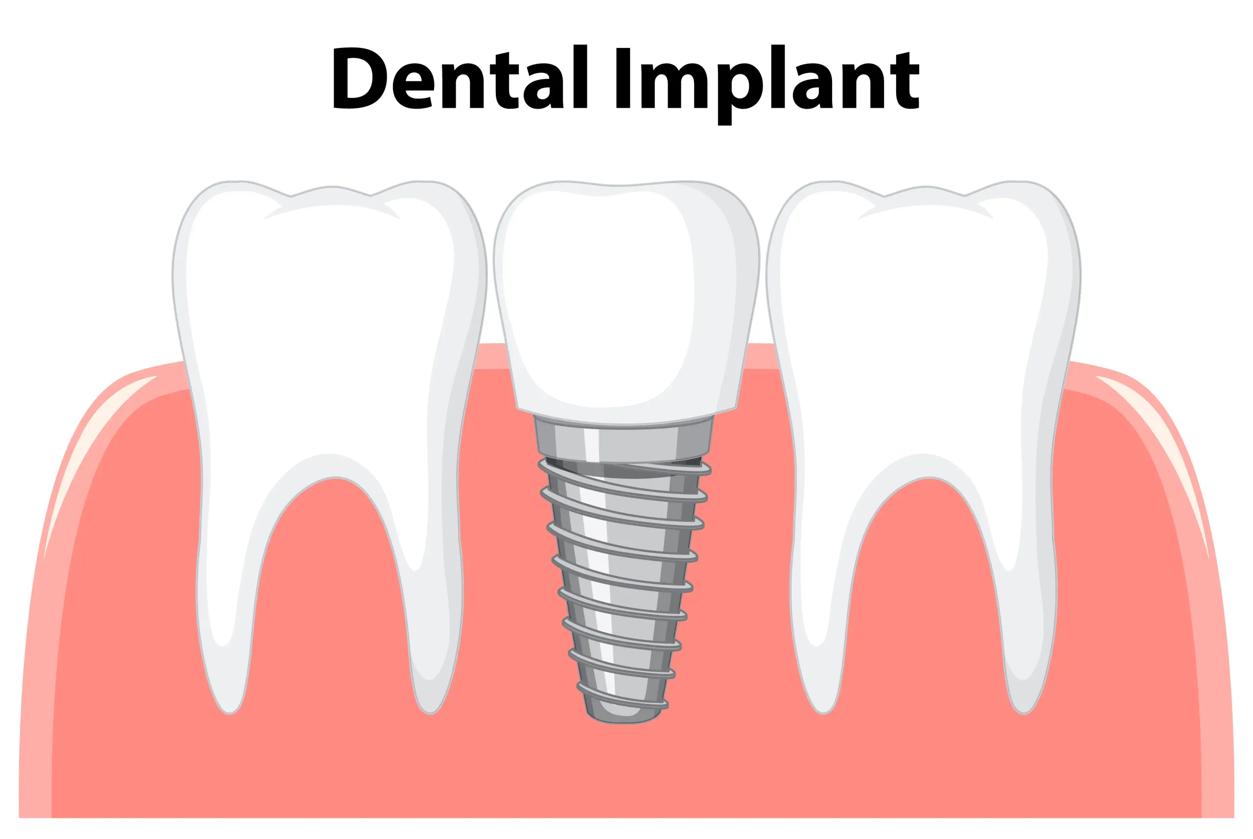 Dental Implant