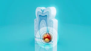 kill tooth pain nerve in 3 seconds permanently