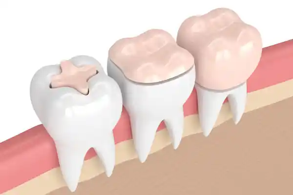 Materials used for dental bridges and restorations