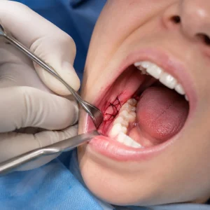 Dentist removing wisdom tooth stitches from a male patient using dental instruments