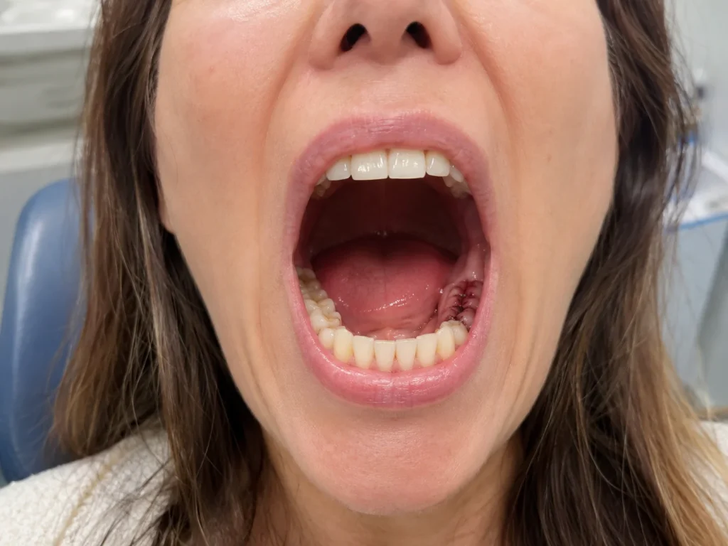 Woman with open mouth showing dissolvable stitches after dental surgery