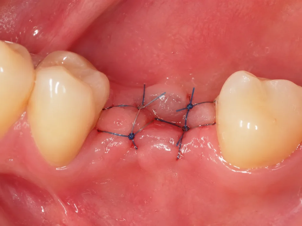 Close up of dissolvable stitches on healing gum after dental surgery