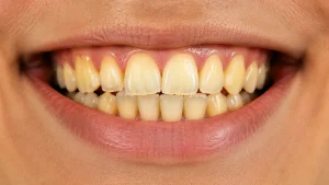 Smile close up showing yellow teeth and natural tooth shade