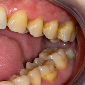 Close-up side view of teeth with yellow staining and plaque buildup near the gumline and molars