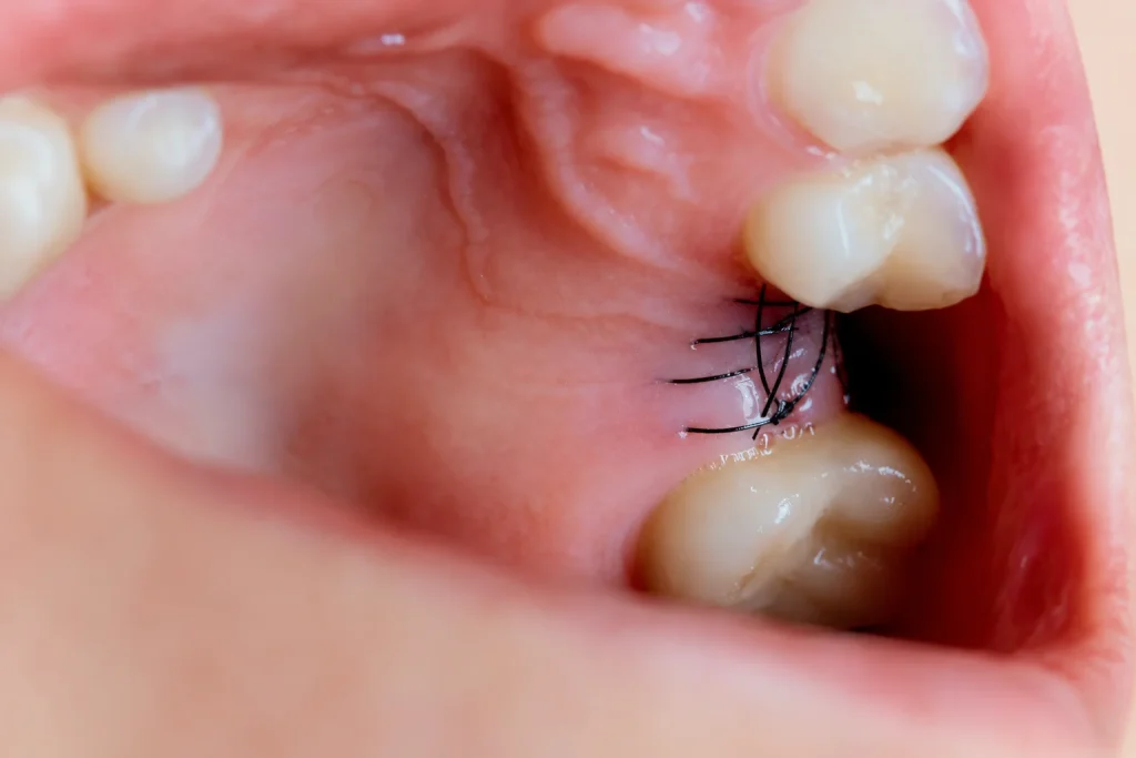 Post-extraction recovery image featuring dissolvable stitches and surrounding molar teeth inside the mouth.