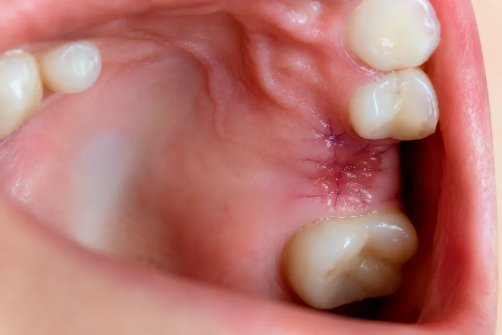Detailed image of dissolvable stitches after tooth extraction securing the healing gum tissue near the back teeth.
