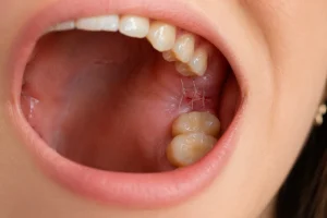 Woman with dissolvable stitches after tooth extraction showing a healing extraction site near the back molars.