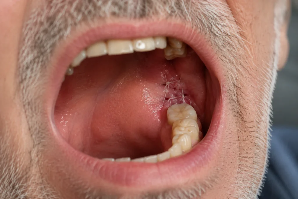Oral surgery recovery with dissolvable stitches visible at the extraction site in an older man's mouth.