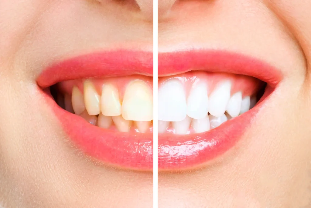 Teeth Whitening Prices