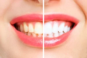 Teeth Whitening Prices