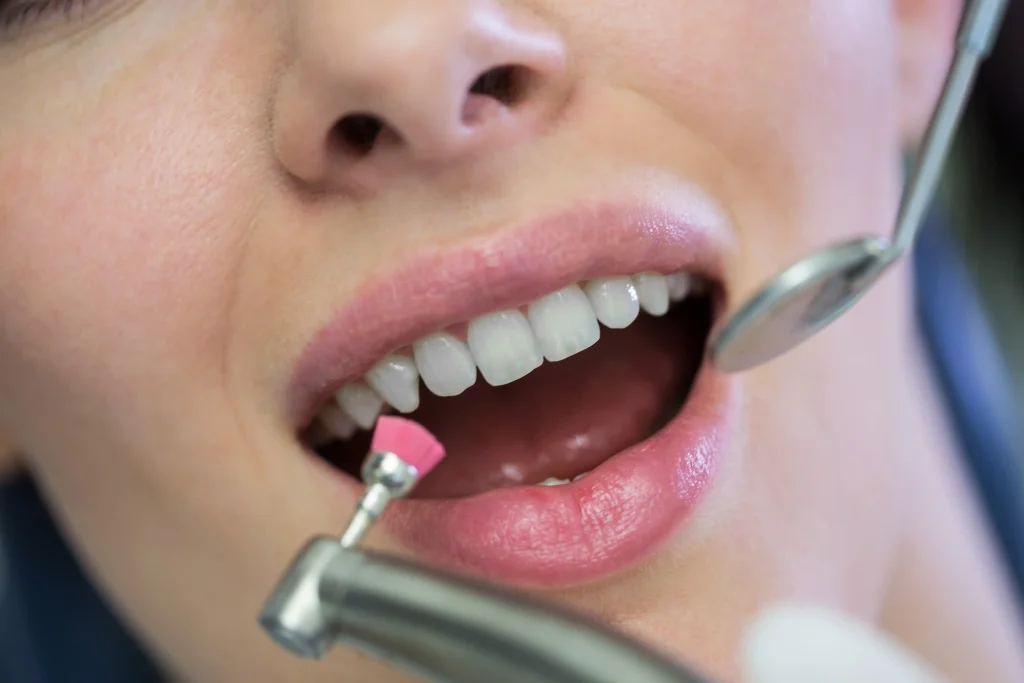 Teeth cleaning