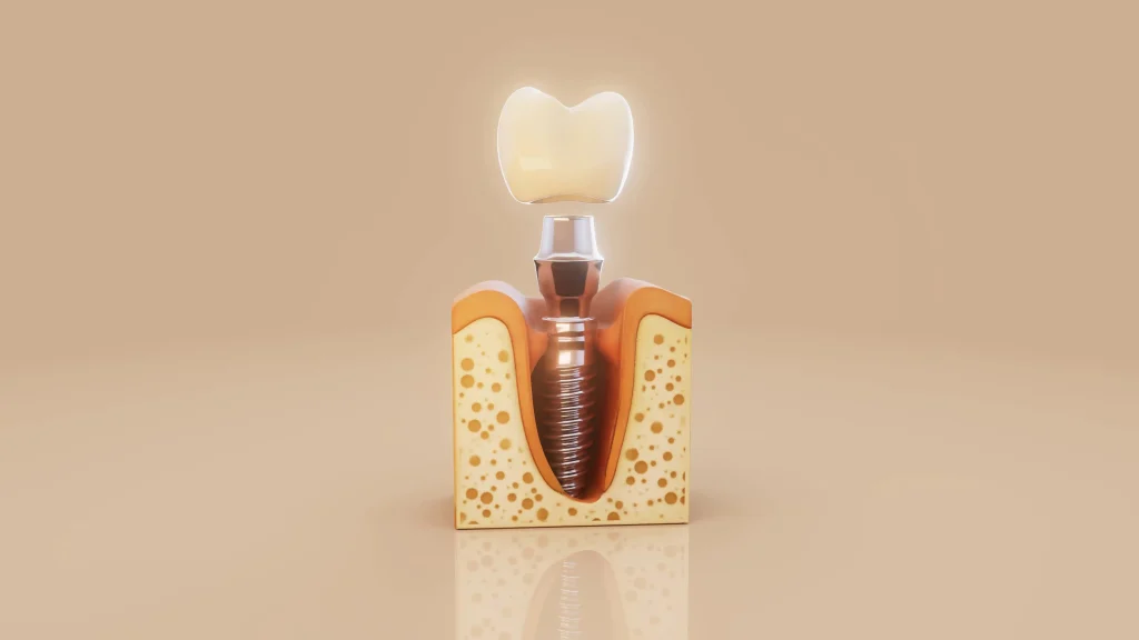 Dental implant cost for replacing a missing tooth with a natural-looking dental implant