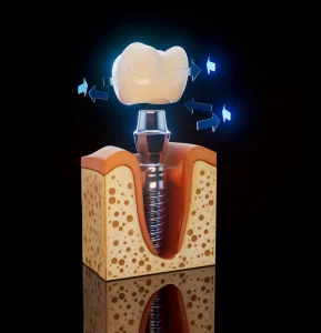 How Much Do Full Mouth Dental Implants Cost in Cudahy?