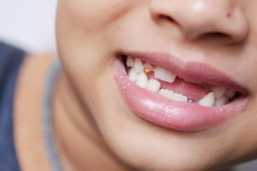 Patient with a missing tooth that may require a dental bridge restoration