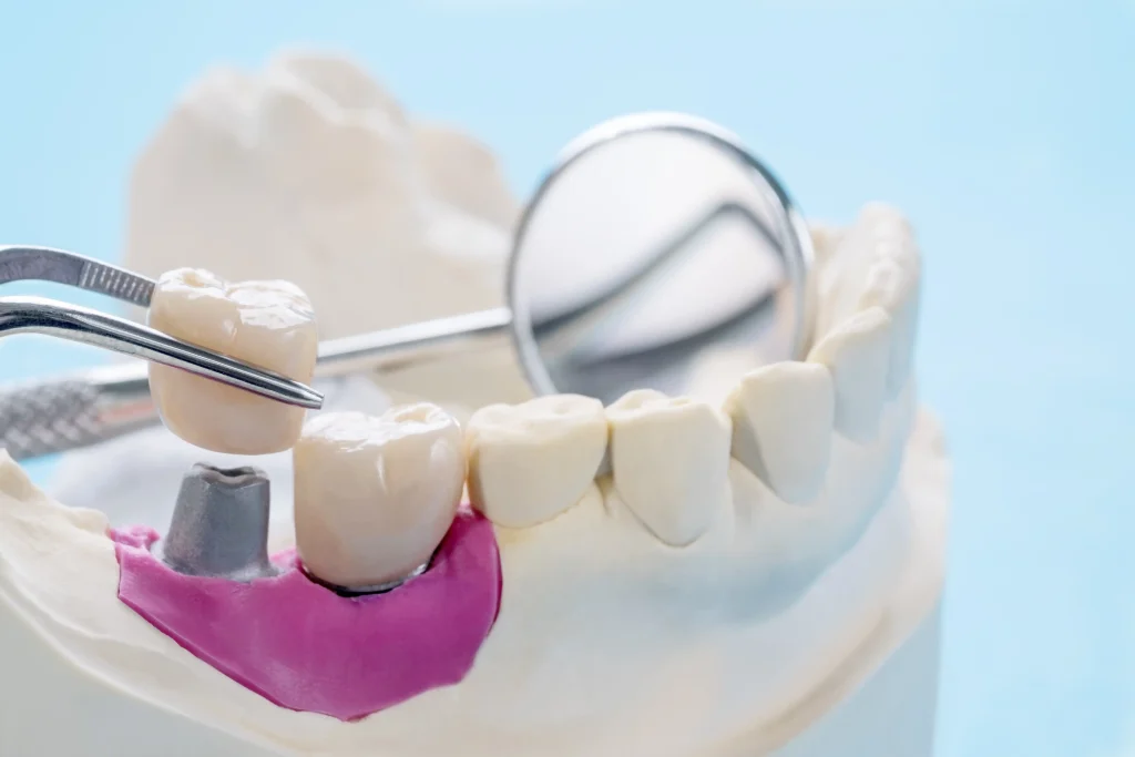 Dental crown cost without insurance shown with a porcelain crown on a dental model