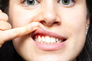 Gums bleeding and signs of gum disease
