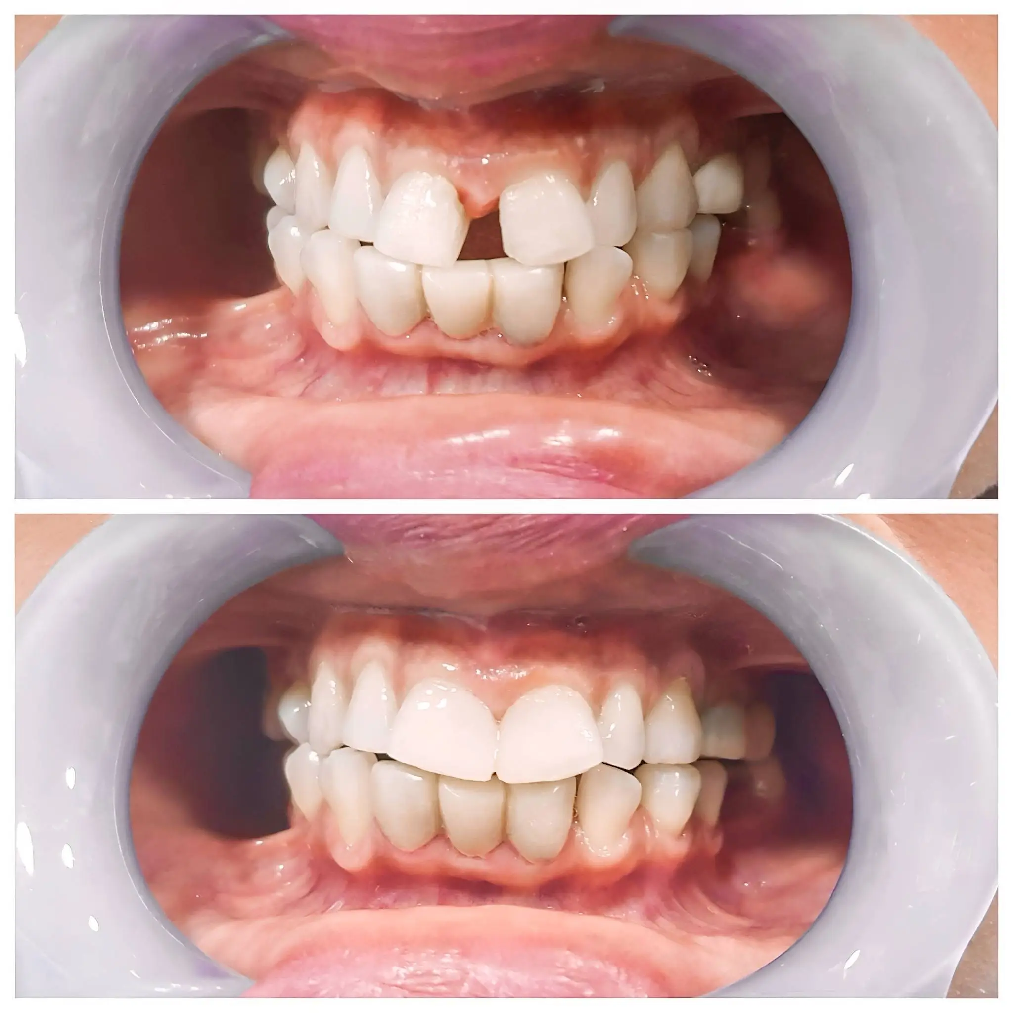 before after fixation huge gap front teeth incisors diastema compressed