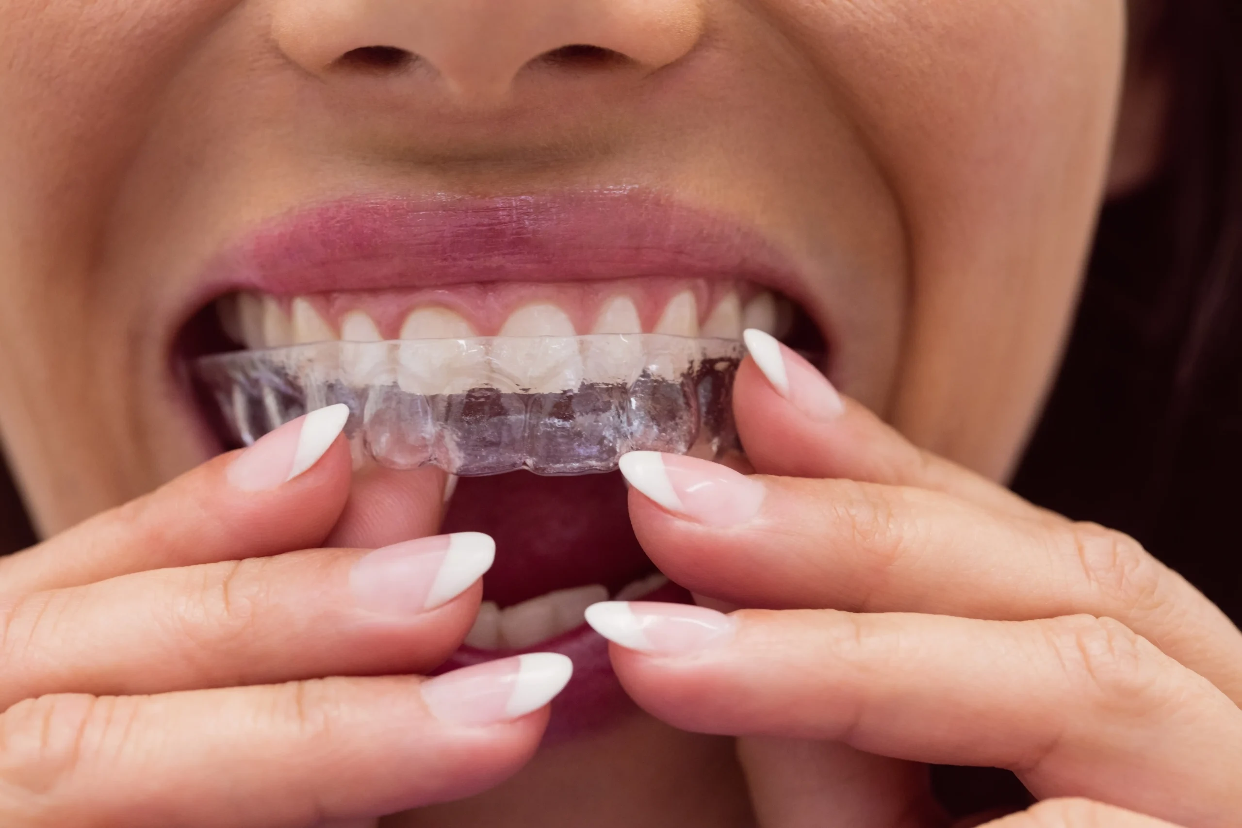 clear aligners Houston tx scaled