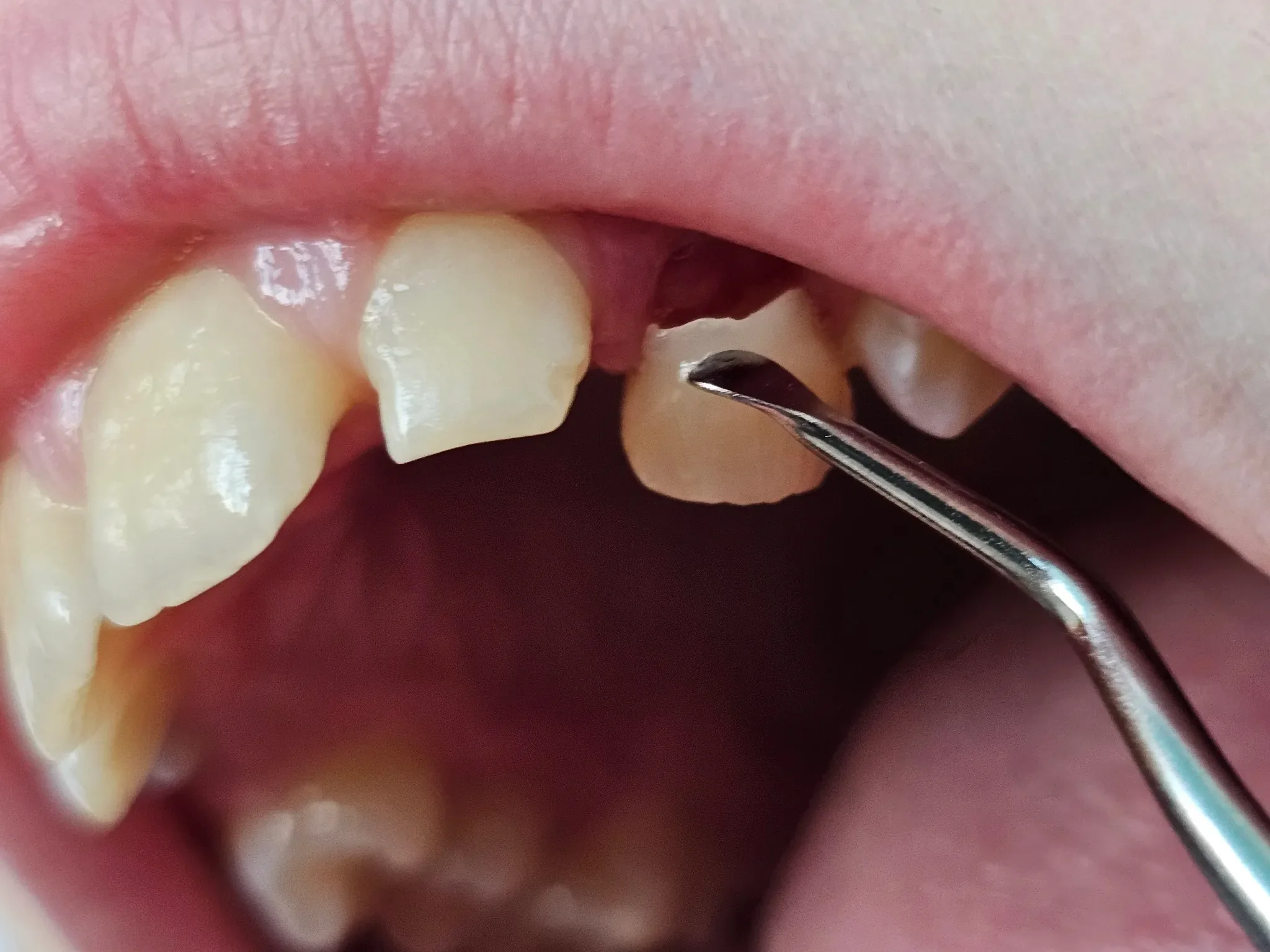 dental checkup shows close view person mouth with dental tool 1