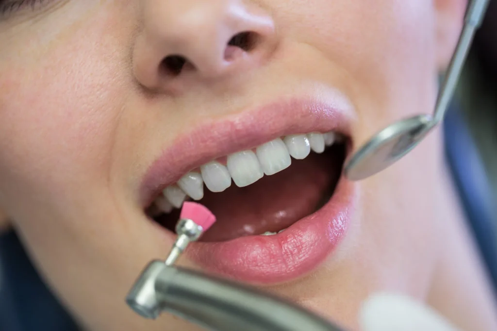Dental Bonding Before and After dental examination