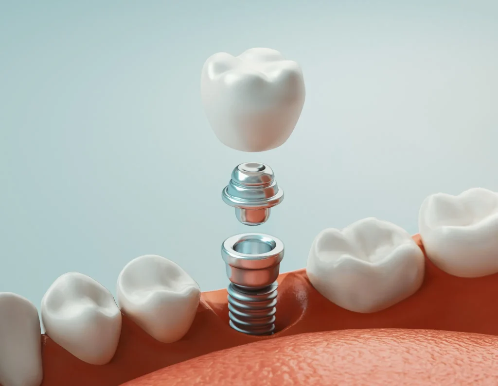 Do Dental Implants Hurt during implant placement