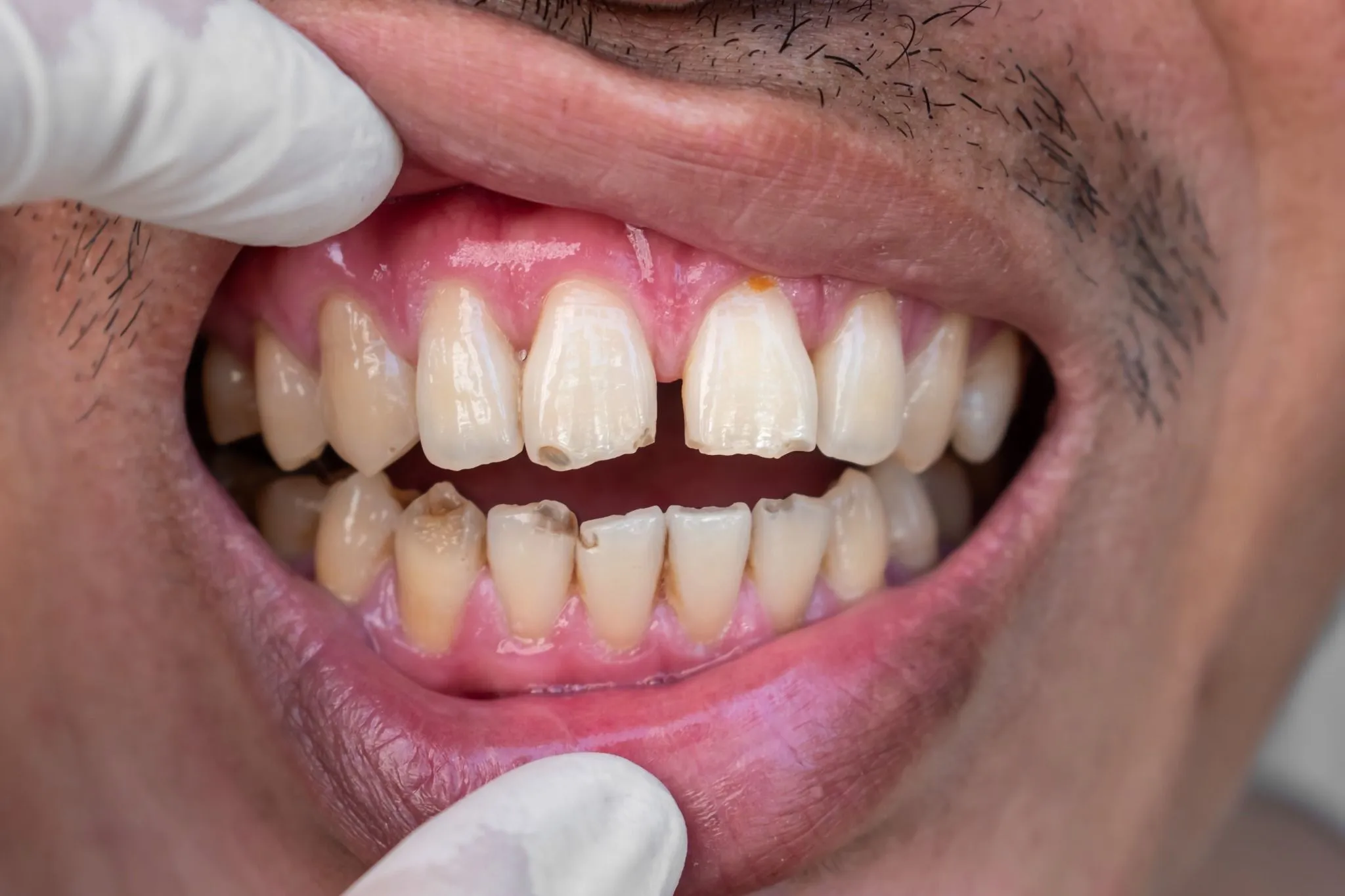 huge gap front teeth incisors diastema cracked chipped teeth compressed
