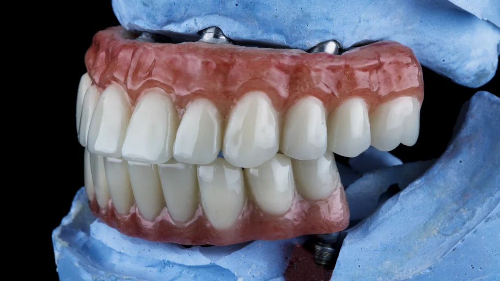 permanent dentures