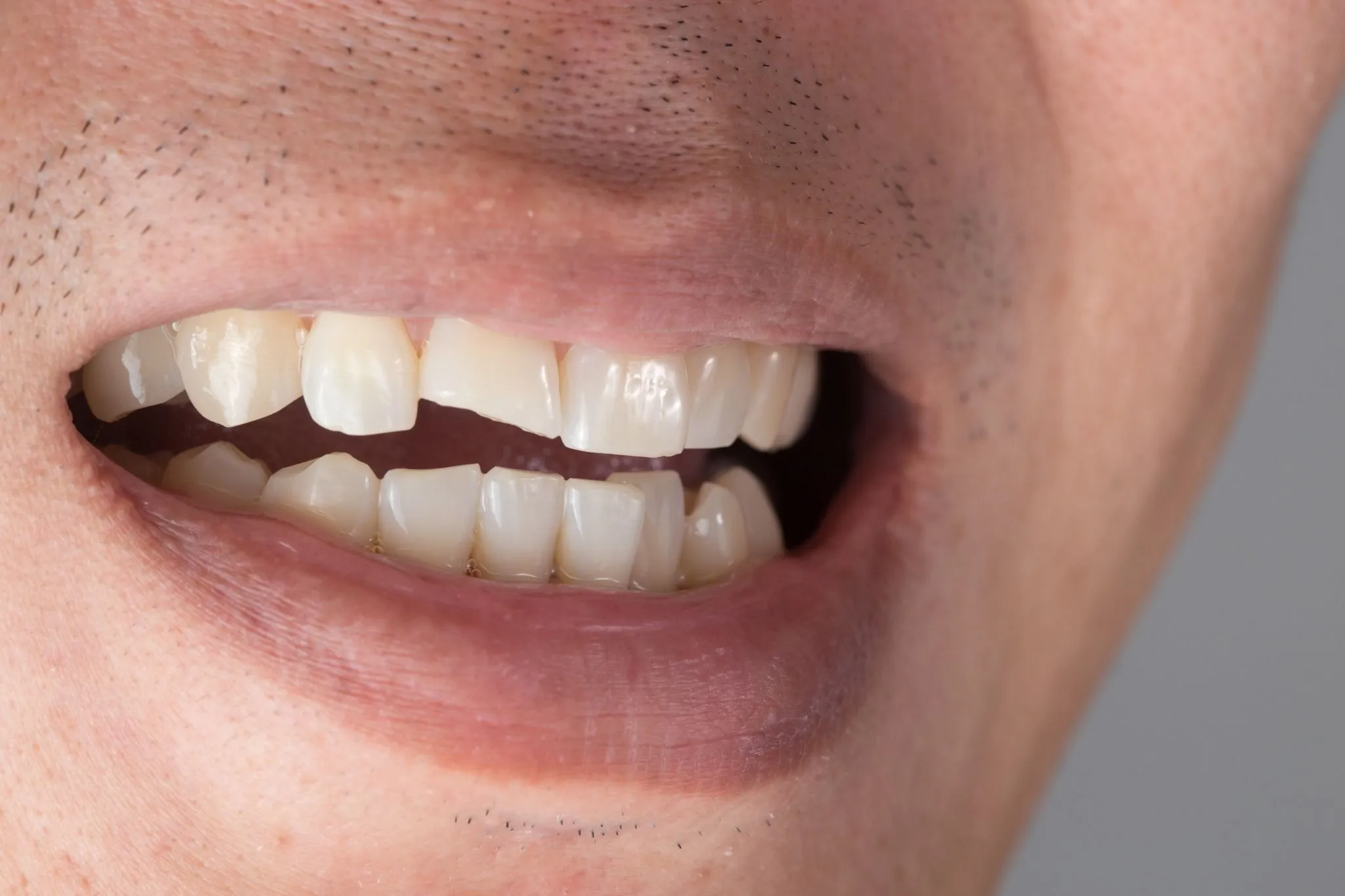 teeth injuries teeth breaking trauma nerve damage injured tooth compressed
